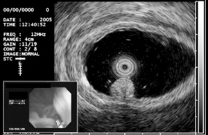 Ultrasound highlighting an adenoma