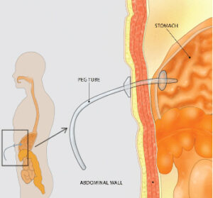 Diagram showcasing stomach peg tube