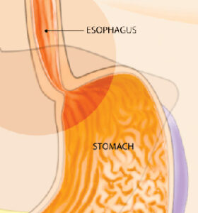 Graphic of esophagus and stomach tube pinching