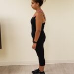 Side view of AR after reshaping procedure