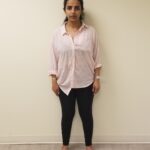 Front image of amal before reshape procedure