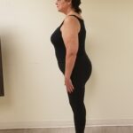 Side view of Greisen after reshaping procedure