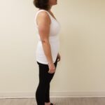 Right side image of JJ after reshape procedure