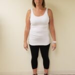 Front Image of JM after reshape procedure