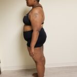 Left side of woman standing before reshape procedure