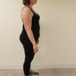 Side Image of JM before reshape procedure