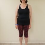 Front view of RG after reshape procedure