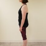 Left view of RG after reshape procedure