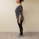 Side image of Sessa after reshape procedure