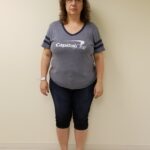 Front image of Sessa before reshape procedure