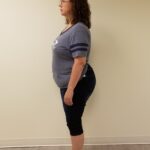 Side image of Sessa before reshape procedure