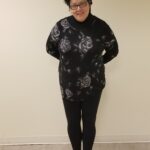 Front view of SG before reshaping procedure