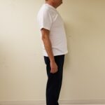 Right side image of tp after reshape procedure