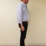 Side Image of TP before reshape procedure