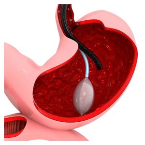 Gastric balloon visual